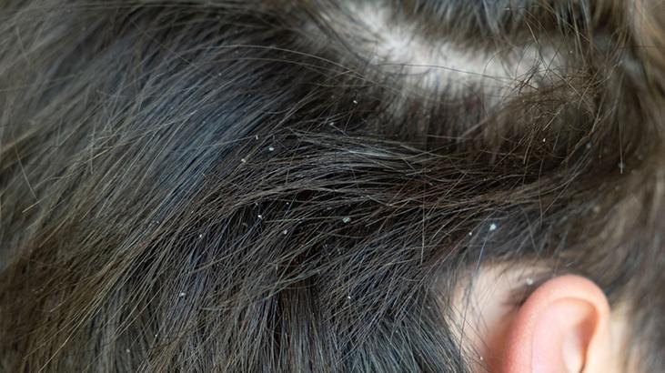 Yumuşatıcılar rafa kalksın, sabun tozları ortaya çıksın Bu 3 yöntem egzamayı bitiriyor