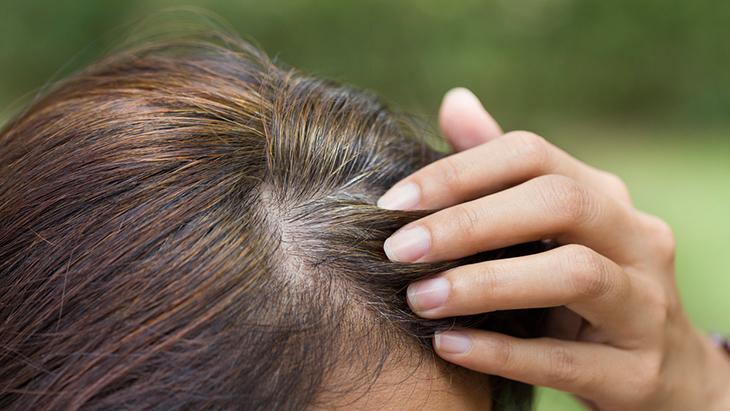 Genç yaşta saçları beyazlatan 6 neden Önlemek mümkünmüş, sırrı burada saklı