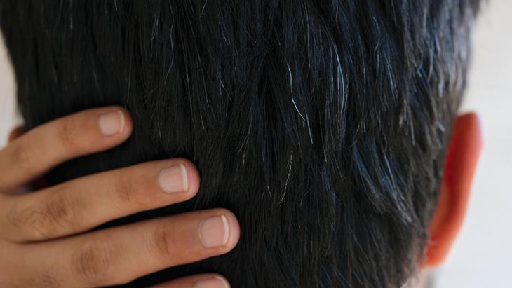 Genç yaşta saçları beyazlatan 6 neden Önlemek mümkünmüş, sırrı burada saklı