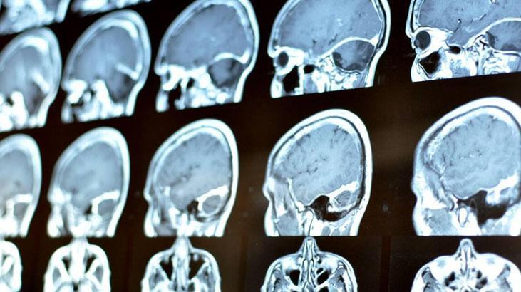 Ölümcül tümöre erkenden teşhis Yeni çıkan kan testi her şeyi değiştirebilir