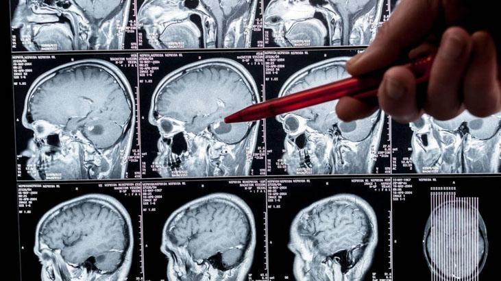 Ölümcül tümöre erkenden teşhis Yeni çıkan kan testi her şeyi değiştirebilir