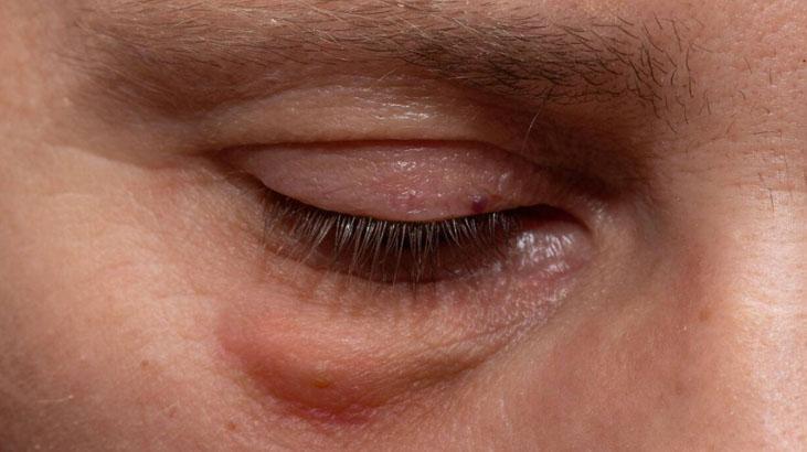 Göz altındaki şişlikler neden olur