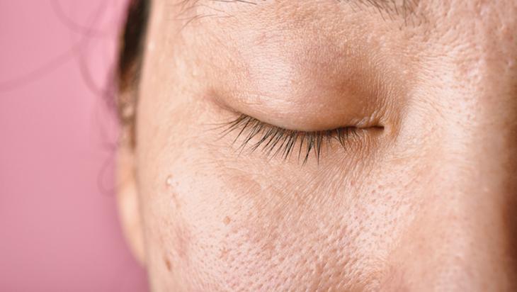 Bu meyveleri yiyin, gerisini düşünmeyin Koyu cilt lekelerinden kurtarıyor