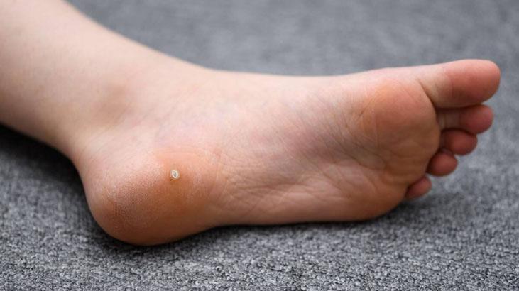 Ayaktaki nasır derdine elveda Kırdıktan sonra kabuğunu atmayın, yumuşacık yapıyor