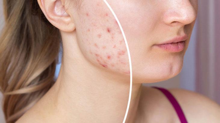 Artan cilt lekelerinin suçlusu meğer bu eksiklikmiş Haftada 1 kez yenirse silgi gibi siliyor Artan cilt lekelerinin suçlusu meğer bu eksiklikmiş Haftada 1 kez yenirse silgi gibi siliyor