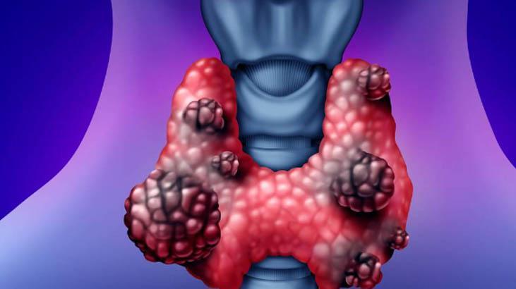 En sık görülen tiroid rahatsızlığı: Hashimoto Hastalığı En sık görülen tiroid rahatsızlığı: Hashimoto Hastalığı