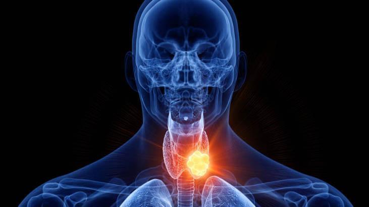 Eksik olan tiroid hormonunun takviyesi ile tedavi edilir Eksik olan tiroid hormonunun takviyesi ile tedavi edilir