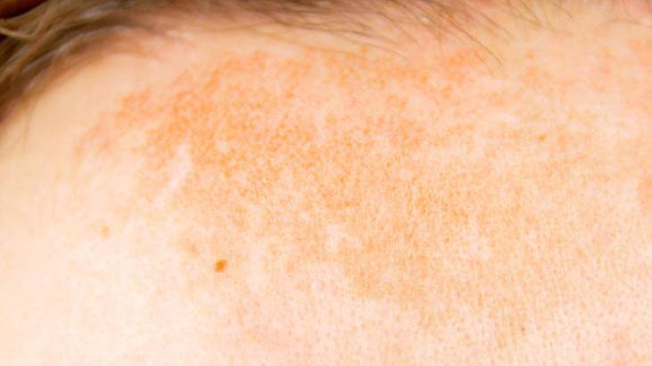 Güneş lekelerini yok eden doğal ilaç Evinizde yetiştirin, şifası içindeki jelde saklı Güneş lekelerini yok eden doğal ilaç Evinizde yetiştirin, şifası içindeki jelde saklı