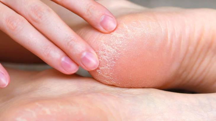 5. Ponza Taşı ile Peeling