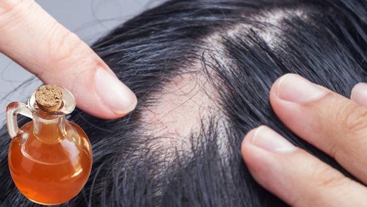 Kel bırakan saç kırana 20 dakikada çözüm Meğer çok basitmiş, her evde var Kel bırakan saç kırana 20 dakikada çözüm Meğer çok basitmiş, her evde var