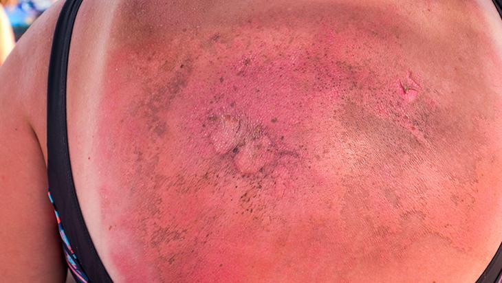 Güneş kremi seçerken bunlara dikkat edin Birçok kişi yanlış biliniyor, miktarı çok önemli Güneş kremi seçerken bunlara dikkat edin Birçok kişi yanlış biliniyor, miktarı çok önemli