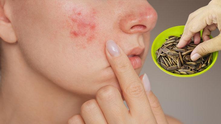 Dudağımız acıyana kadar çitliyoruz Kimse bilmiyor ama sivilce yapmayanı da var