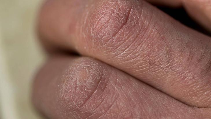 Bu kış cildiniz neme doysun Cildiniz cam gibi olacak, bu adımları atlamayın