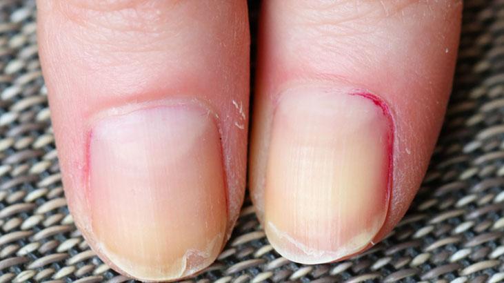Kırılan tırnak canınızı sıkmasın Çaresi metal törpü değil, mikrop hücum ediyor