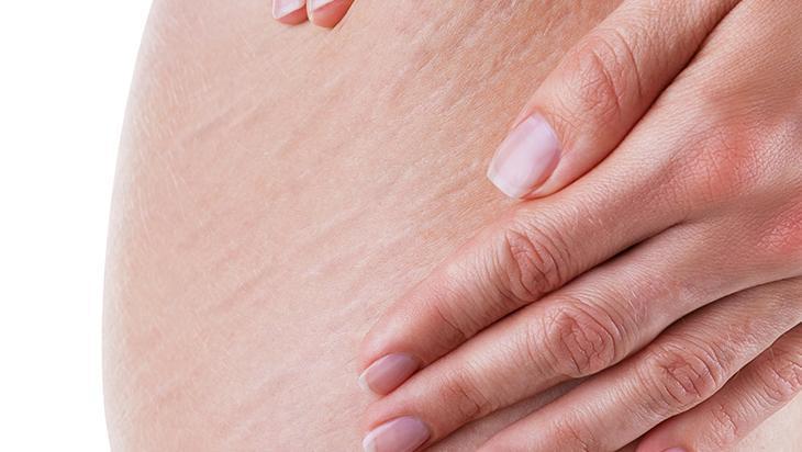 Bacaktaki, göbekteki çatlakları silgi gibi silen taktik 2 malzeme mucize yaratıyor