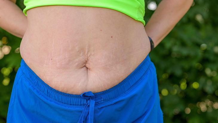 Bacaktaki, göbekteki çatlakları silgi gibi silen taktik 2 malzeme mucize yaratıyor