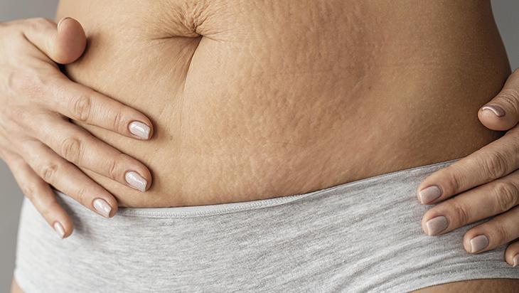 Bacaktaki, göbekteki çatlakları silgi gibi silen taktik 2 malzeme mucize yaratıyor