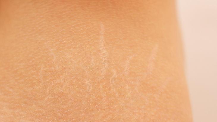 Bacaktaki, göbekteki çatlakları silgi gibi silen taktik 2 malzeme mucize yaratıyor