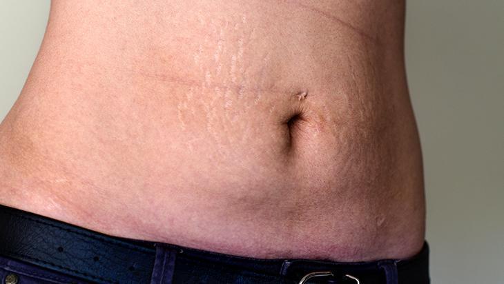 Bacaktaki, göbekteki çatlakları silgi gibi silen taktik 2 malzeme mucize yaratıyor