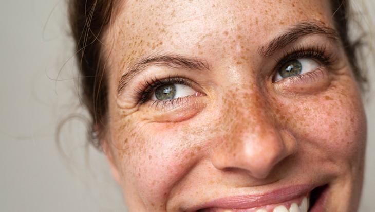 Çillerden saniyeler içinde kurtaran karışım Seruma, kreme hiç gerek yokmuş Çillerden saniyeler içinde kurtaran karışım Seruma, kreme hiç gerek yokmuş