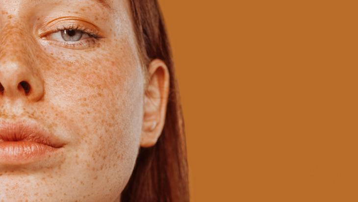 Çillerden saniyeler içinde kurtaran karışım Seruma, kreme hiç gerek yokmuş Çillerden saniyeler içinde kurtaran karışım Seruma, kreme hiç gerek yokmuş