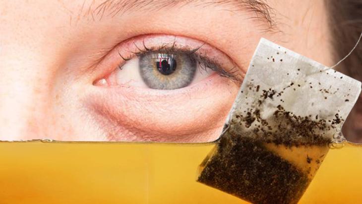 Göz altı torbası değil yağ fıtığı Çaresi poşet çayda saklı