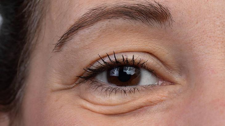 Göz altı torbası değil yağ fıtığı Çaresi poşet çayda saklı