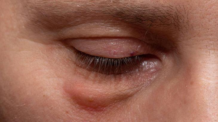 1- Soğuk bir göz maskesi yapın