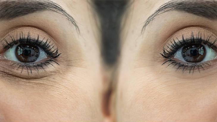 Göz altı torbası değil yağ fıtığı Çaresi poşet çayda saklı