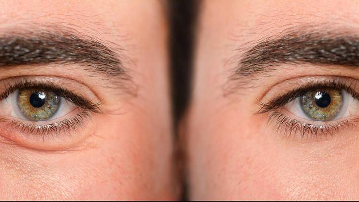 Göz altı torbası değil yağ fıtığı Çaresi poşet çayda saklı