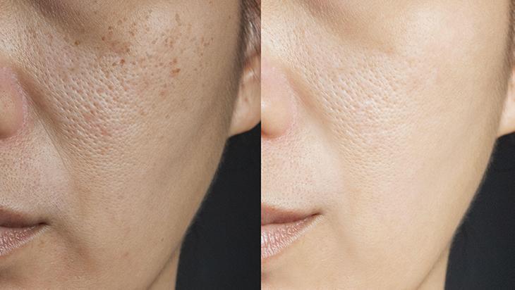 Toksinleri atarak sivilceleri önleyen en etkili taktik Bol bol için, şifa dağıtıyor