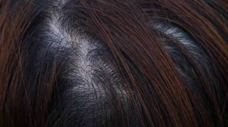 Saçından yağ damlayanlara özel tarif İlk seferde etki ediyor, her gün yıkamaya son