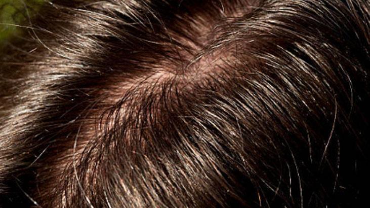 Saçından yağ damlayanlara özel tarif İlk seferde etki ediyor, her gün yıkamaya son