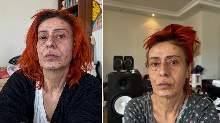 Yıldız Tilbe evde saçını boyadı, kimyasal yanık oldu Meğer gerçek başkaymış