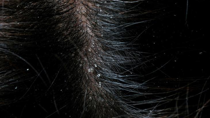 Pahalı bakımları aratmıyor, elma sirkesi varsa tamam Saçı durulamak yetiyor