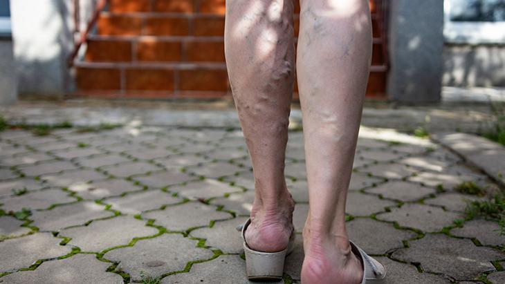 Hareketsiz yaşam ve obezite riski artırıyor