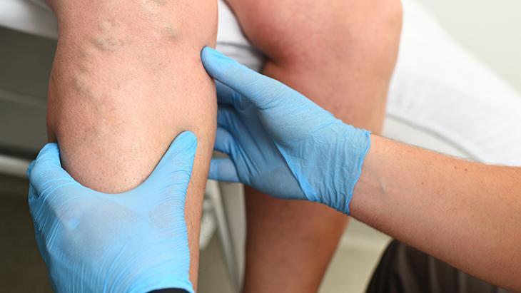 Derin ven trombozuna karşı 5 etkili öneri