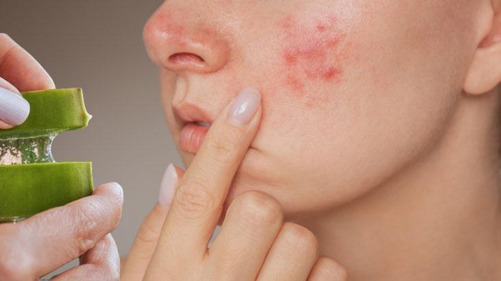 Sadece bir ürünle kökünü kurutan etki Sivilceler 2 gün sonra görünmüyor