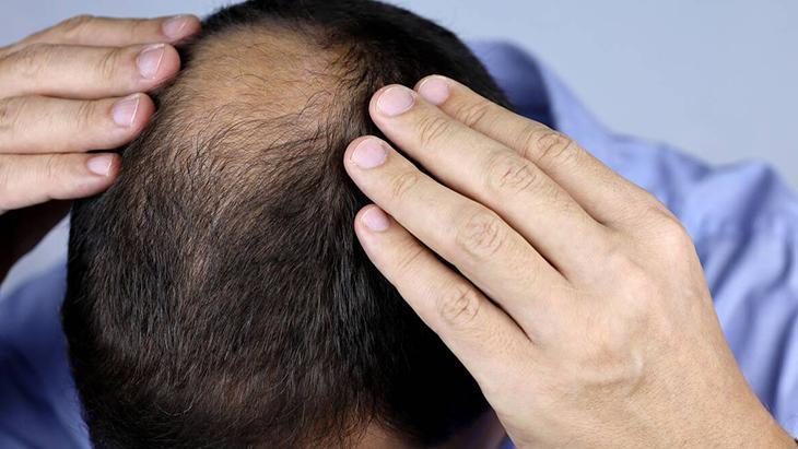 Saç dökülmesinde popüler çözüm: Biberiye Haftada 2 veya 3 kez kullanmak yeterli Saç dökülmesinde popüler çözüm: Biberiye Haftada 2 veya 3 kez kullanmak yeterli