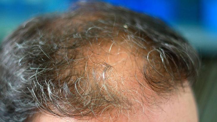 Saç dökülmesinde popüler çözüm: Biberiye Haftada 2 veya 3 kez kullanmak yeterli Saç dökülmesinde popüler çözüm: Biberiye Haftada 2 veya 3 kez kullanmak yeterli