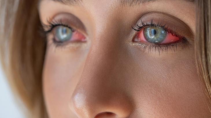 Kırmızı veya pembe göz