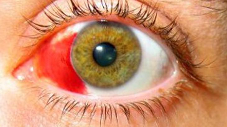 Gözdeki kırmızılıkları ciddiye alın