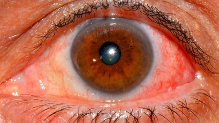 Romatizmal, hormonal ve dermatolojik hastalıklara neden olabilir