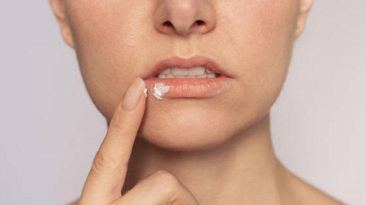 Çatlamış dudaklara pişik kremi tüyosu Boşuna para dökmeyin, 1 gecede çözüyor