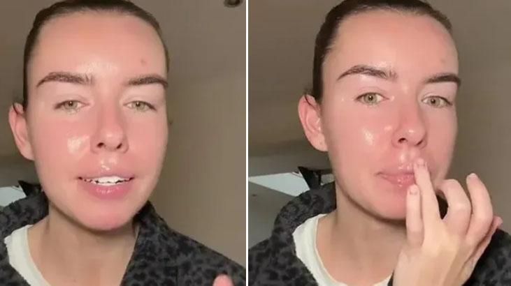 Çatlamış dudaklara pişik kremi tüyosu Boşuna para dökmeyin, 1 gecede çözüyor