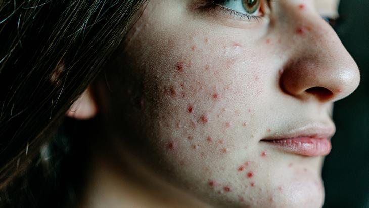 Akneye karşı 3 önemli öneri