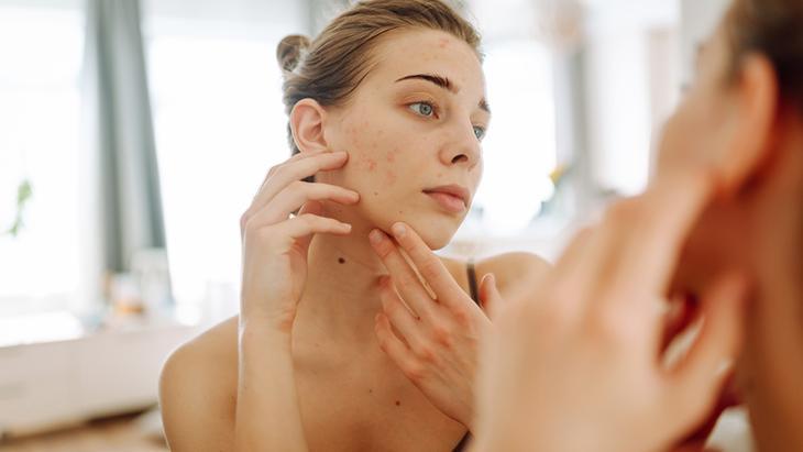 Alın, çene veya sırtta görülüyor Akne hangi bölgede neye işaret ediyor