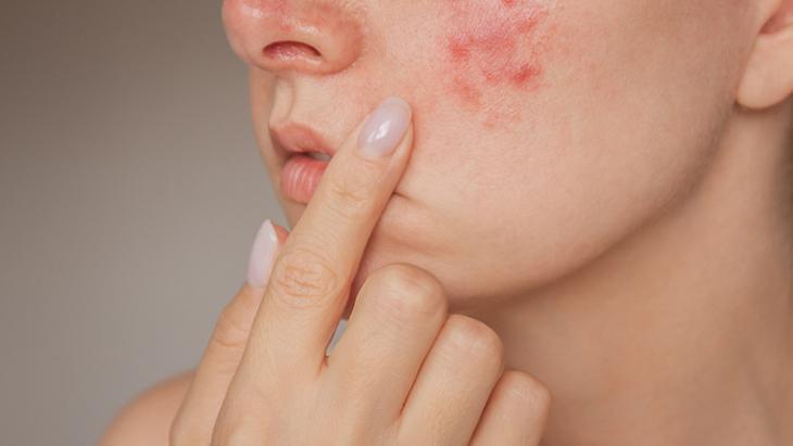 Akne izleri bu yöntemlerle hafifletiliyor
