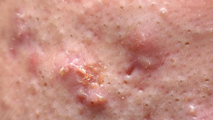 Vitamin de ne yapar demeyin Sivilceler bir anda bastırıyor, ellerimizle besliyoruz