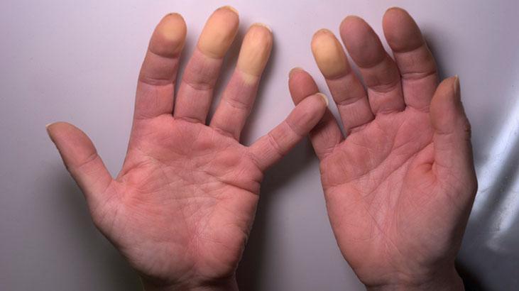 Hipotermiden nasıl korunuruz